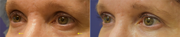 Patient lower blepharoplasty before after picture