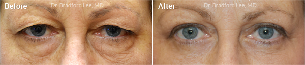 before after photo of quad blepharoplasty procedure
