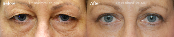 Quad Blepharoplasty