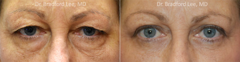 Upper Blepharoplasty Honolulu Upper Eyelid Surgery Hawaii