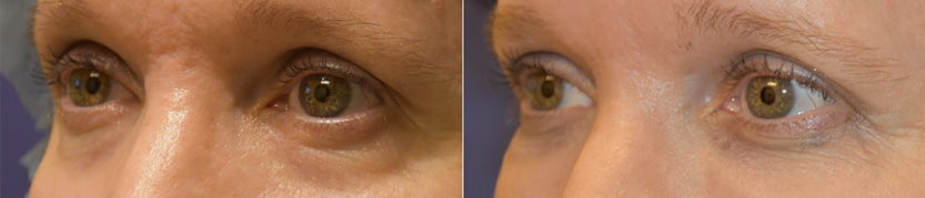 before after photo of Tear Trough Filler