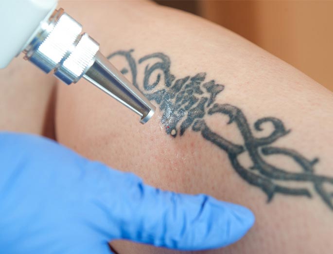 Stock image of tattoo removal image