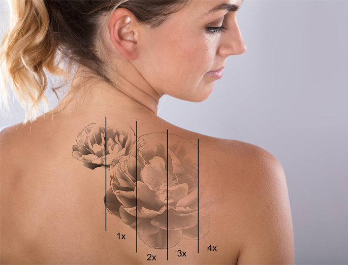 Stock image of tattoo removal image