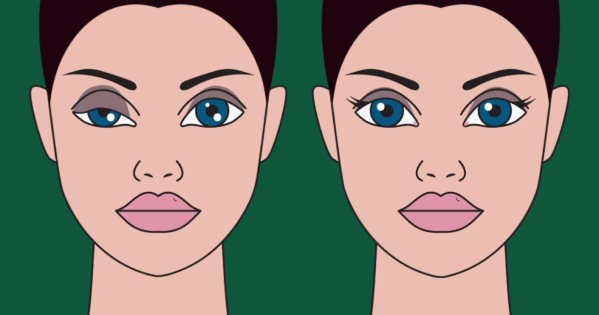 Comparison between two women with droopy eyelids and regular eyelids.