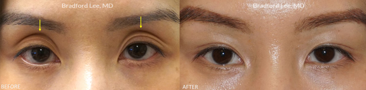 Dermal filter before and after patient image2