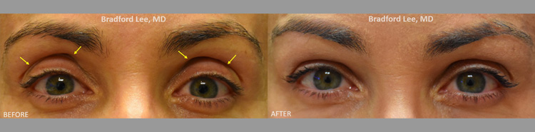 This 51-year-old lady was bothered by hollowing of the upper lids and vertical elongation of the upper eyelid platform that gave her an aged appearance. She underwent dermal filler injections to the superior sulcus resulting in improvement of the hollowing, reduced upper eyelid platform show, and a more alluring and youthful contour to the upper eyelids.