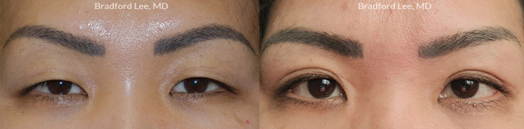 Asian Blepharoplasty before and after patient image4