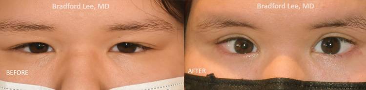 This 16-year-old Asian/Latina patient was bothered by her squinty eyes, heavy upper eyelids, and lower lids with lashes that curled inwards and rubbed on her corneas. She underwent an Asian upper blepharoplasty and lower lid epiblepharon repair to open the eyes, improve the visibility of her eyelid crease, and rotate the lashes on the lower eyelids away from the eyes.