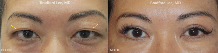 This 40+ year-old Asian lady was bothered by excess upper eyelid skin, heavy upper lids, and a low upper eyelid crease that covered the platform of the upper eyelid. She underwent an Asian blepharoplasty to remove excess skin, define a more prominent upper lid crease, and improve the visibility of the upper eyelid platform.