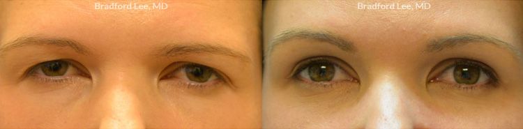 Browlift before and after patient image1