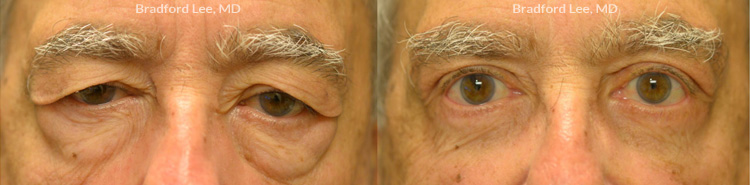 This 76-year-old man was bothered by lateral drooping of the eyebrows, excess upper eyelid skin, and prominent fat prolapse on the lower eyelids. He underwent a lateral brow lift and quad blepharoplasty for a dramatic yet natural-appearing improvement of the entire periocular region.