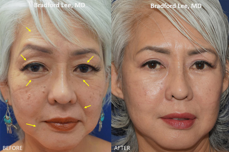 This 60+ year-old lady was bothered by excess skin on the upper and lower eyelids as well as mid-face descent, and mild jowling. She underwent a quad blepharoplasty, upper lid ptosis repair, and mini-facelift to restore a more youthful appearance to the eyes and face.