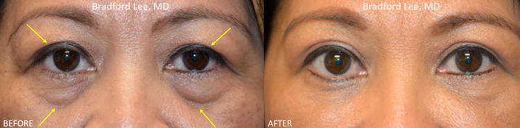 This 52-year-old Asian lady was bothered by excess skin covering her eyelid crease, a smaller aperture of the left eye, and dramatic hollowing along the lower lids into the cheek. She underwent a left ptosis repair, upper blepharoplasty, and liposuction with fat transfer to the lower eyelids to improve the symmetry of the eye apertures, improved definition of the upper lid creases, and a rejuvenated appearance to the lower eyelids.