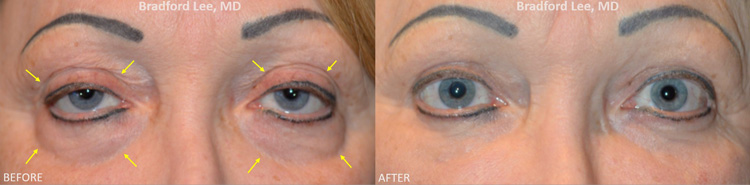 Fat Transfer before and after patient image3