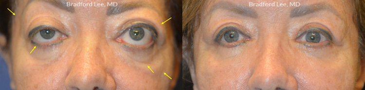 This 60+ year-old lady with thyroid eye disease was bothered by the bulging of her eyes, lower eyelid retraction, excess skin on both upper and lower eyelids, and age-related atrophy of the temples, under eye region, and cheeks. She underwent bilateral orbital decompression surgery, eyelid retraction repair, quad blepharoplasty, and fat transfer to the temples, cheeks, and lower lids to reduce the bulging of the eyes, improve the position and symmetry of the eyelids, and restore youthful facial contours in the periocular region.