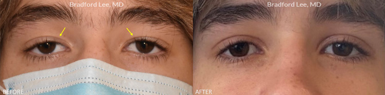 This 18-year-old man was bothered by drooping of the upper eyelids and a low eyelid crease with mild excess skin. He underwent a conservative upper blepharoplasty and ptosis repair to subtly open his eyes and create a higher and more defined upper eyelid crease.