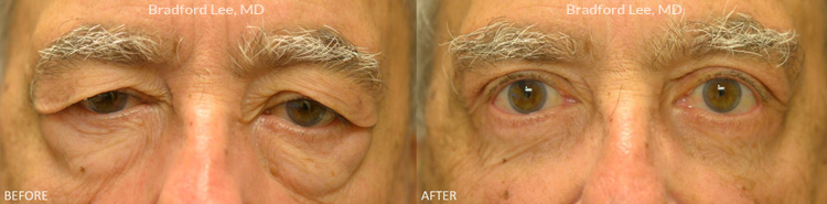 This 76-year-old man was bothered by lateral drooping of the eyebrows, excess upper eyelid skin, and prominent fat prolapse on the lower eyelids. He underwent a lateral brow lift and quad blepharoplasty for a dramatic yet natural-appearing improvement of the entire periocular region.