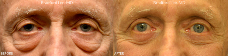 Male Blepharoplasty before and after patient image4