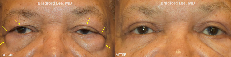 This 70-year-old man presented with ptosis of the left upper eyelid, excess skin on the upper lids, lateral brow ptosis, and prominent fat prolapse on the lower eyelids. He underwent a left upper lid ptosis repair, bilateral internal browpexy, and quad blepharoplasty to open his left eye, support the tail of the brows, and remove the excess skin and fat on the upper and lower eyelids.