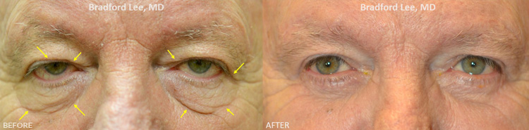 This 74-year-old man was bothered by upper lid ptosis, sagging of the lower eyelids, and excess skin on the upper and lower eyelids. He underwent a bilateral upper lid ptosis repair with quad blepharoplasty to raise both upper eyelids and remove excess skin and tighten the eyelids. This resulted in a brighter and enhanced appearance of the eyes while maintaining a natural appearance.