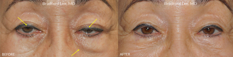 This 72-year-old lady presented with droopy upper eyelids and excess puffiness on the left lower eyelid. The patient underwent a conservative upper lid ptosis repair to open her eyes, and a left lower lid skin-pinch blepharoplasty with dermal filler injection to the left tear trough region to improve her lower lid symmetry.