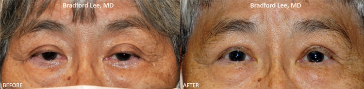 This 80-year-old lady presented with asymmetric ptosis of the upper eyelids and upper eyelid crease asymmetry that made her appear tired and sleepy. She underwent a bilateral upper lid ptosis repair resulting in brightening of her eyes and improvement in her peripheral vision.