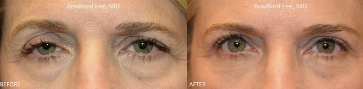 This 57-year-old patient presented with asymmetric ptosis of the upper eyelids that made her look tired and with one eye bigger than the other. She was also bothered by drooping of the left brow that made her brows look asymmetric. The patient underwent a bilateral upper lid ptosis repair and blepharoplasty, as well as a left brow ptosis repair to improve her eyebrow symmetry.
