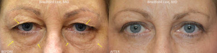 This 51-year-old lady complained of excess skin on the upper lids that was resting on the lashes and covering the area where she used to be able to apply eye shadow. She was also bothered by the puffiness, tear trough hollowing, and skin textural changes on the lower lids. She underwent a bilateral upper and lower blepharoplasty for a dramatic yet natural-appearing enhancement of the upper and lower eyelids.