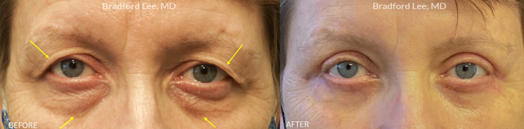 Quad Blepharoplasty before and after patient image2