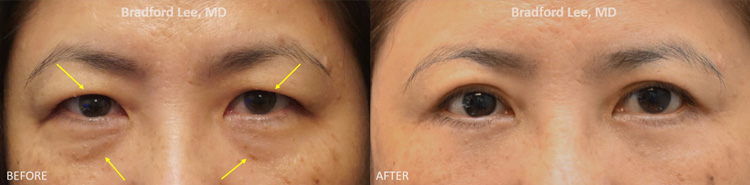 This 50+ year-old Asian lady was bothered by puffiness of the upper lids, excess skin, and lack of a visible eyelid crease but wanted something very conservative and natural-looking. She was also bothered by subtle fat prolapse, excess skin, and tear trough hollowing along the lower lids. She underwent an Asian upper blepharoplasty with lid crease formation and a fat-transposition lower blepharoplasty resulting in a visible upper eyelid crease and refreshed appearance for the upper and lower lids.