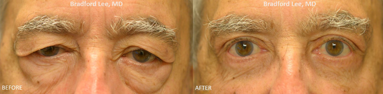 Quad Blepharoplasty before and after patient image4