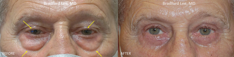 This 71-year-old man was bothered by upper lid ptosis as well as excess skin on the upper lids and “bags” on the lower lids. He underwent a bilateral upper lid ptosis repair and quad blepharoplasty resulting in brightening of the eyes, improved peripheral vision, and a refreshed appearance of the eyes.