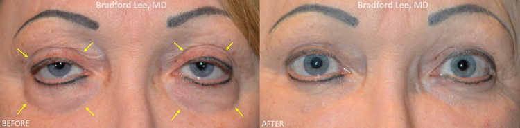 Revision Eyelid Surgery before and after patient image1