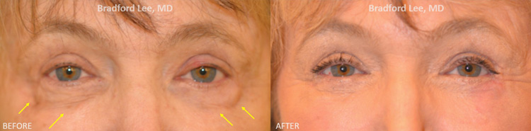 This 60+ year-old lady saw a general plastic surgeon who performed fat transfer to the lower lids that resulted in bulging lumps of fat on the lower eyelids without improvement in her lower lid hollowing. She underwent a revision procedure with Dr. Lee, including a lower blepharoplasty with fat repositioning, liposuction with fat transfer to the under eye region, and laser skin resurfacing for a smoother, more youthful contour to the lower eyelids.