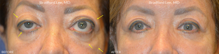 This 60+ year-old lady with thyroid eye disease was bothered by the bulging of her eyes, lower eyelid retraction, excess skin on both upper and lower eyelids, and age-related atrophy of the temples, under eye region, and cheeks. She underwent bilateral orbital decompression surgery, eyelid retraction repair, quad blepharoplasty, and fat transfer to the temples, cheeks, and lower lids to reduce the bulging of the eyes, improve the position and symmetry of the eyelids, and restore youthful facial contours in the periocular region.