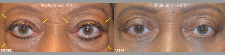 This 67-year-old lady had a history of thyroid eye disease and was bothered by prominent excess fat and skin on the upper and lower eyelids. She underwent a bilateral upper and lower blepharoplasty with orbital fat decompression that subtly improved the bulging of the eyes, softened her expression, and rejuvenated the upper and lower eyelids.