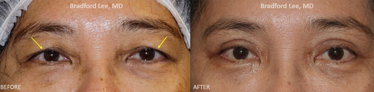 This 55-year-old lady presented with excess upper eyelid skin that was beginning to rest on her lashes, conceal her eyelid crease, and make her upper eyelids look heavy. She underwent an upper blepharoplasty to remove the excess skin, brighten the eyes, define the eyelid crease, and improve visibility of the platform of the eyelid.