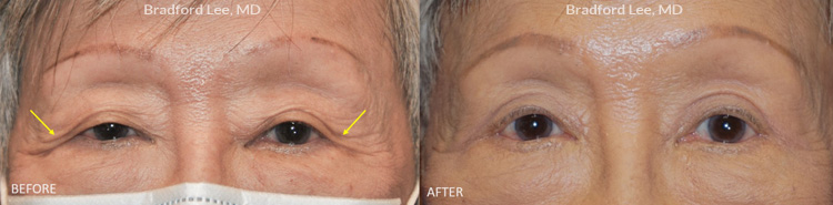 This 80+ year-old Asian lady was bothered by excess skin on the upper lids and lateral hooding of skin. The patient underwent an upper blepharoplasty to remove excess skin, define the eyelid creases, and simultaneously open her eyes.