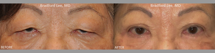 This 74-year-old lady presented with severe upper lid ptosis and excess skin of the upper and lower eyelids. She underwent a bilateral upper blepharoplasty with ptosis repair and bilateral lower blepharoplasty resulting in a dramatic yet natural-appearing enhancement of the upper and lower eyelids.