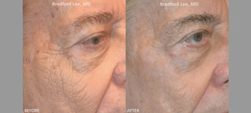 This 60+ year-old male presented with deep wrinkles and textural changes of the cheek. He had 1 session of CO2 laser resurfacing to tighten the skin and smooth the wrinkles and textural changes.