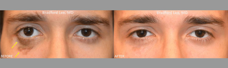 This 21-year-old male presented with a scar on the right lower lid that was causing disfigurement and right lower eyelid retraction. He had 2 sessions of CO2 laser resurfacing to help fade the scar, address the lower lid retraction, and improve the quality and texture of the skin.