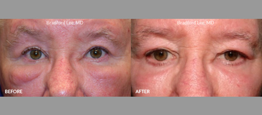 This patient was bothered by “festoons” of the lower eyelid, which are collections of fluid that cause fluctuating eyelid swelling of the lower lids. He underwent two sessions of CO2 laser resurfacing to tighten the skin and improve the festoons.