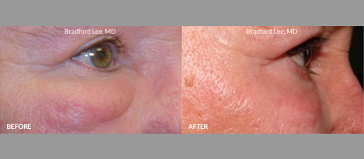 This patient was bothered by “festoons” of the lower eyelid, which are collections of fluid that cause fluctuating eyelid swelling of the lower lids. He underwent two sessions of CO2 laser resurfacing to tighten the skin and improve the festoons.