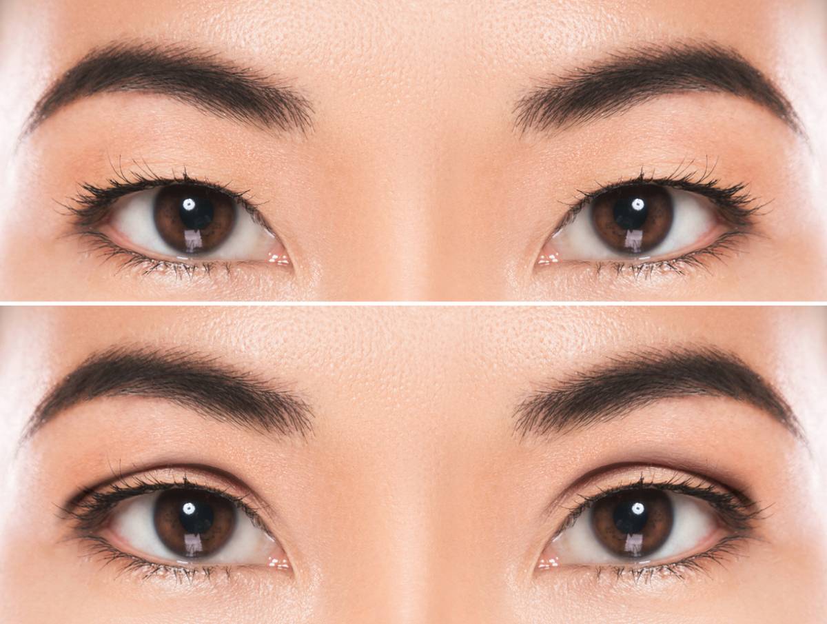 featured image for best age for double eyelid surgery blog