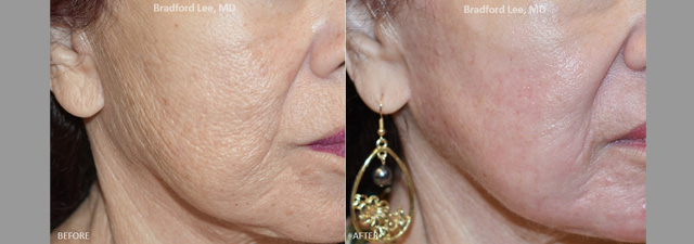 This 77-year-old patient was bothered by deep wrinkles and textural skin changes and was looking for a dramatic way to rejuvenate the skin. She had two sessions of CO2 laser resurfacing and was able to achieve smoother, more radiant skin that helped stimulate collagen and removed years of sun damage.