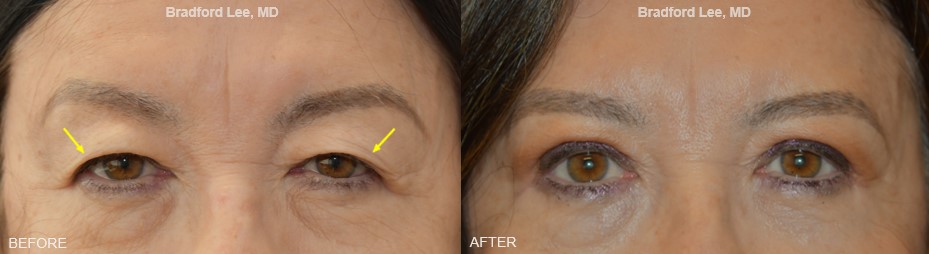 This 68-year-old patient presented with excess skin drooping over her upper eyelids, causing shadowing. She underwent an upper lid blepharoplasty to achieve a revitalized and refreshed look. *This photo was taken at 3 months post-op, and the mild residual redness/swelling on the upper lids will continue to resolve over time.*