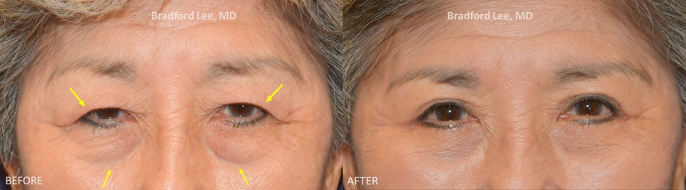 This 78-year-old lady complained of the excess skin resting on her eyelashes, causing visual impairment. She was also bothered by the puffiness of her lower eyelids. She underwent a bilateral upper and lower blepharoplasty for a natural but youthful enhancement of her upper and lower lids.