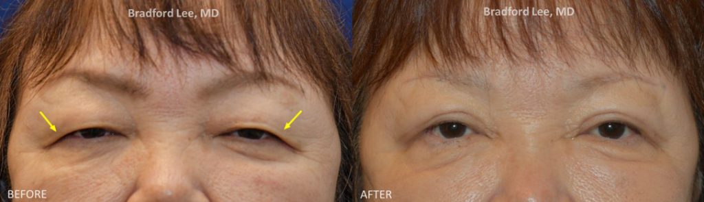 This 67-year-old patient complained of her eyelashes impairing her vision due to her droopy upper eyelids. She underwent an upper lid blepharoplasty to improve her vision and refresh her appearance. *This photo was taken at 3 months post-op, and the mild residual redness/swelling will continue to resolve over time.*