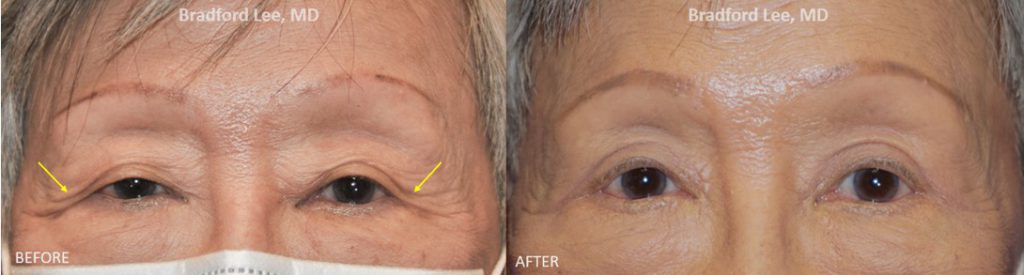 This 80+ year-old patient was bothered by excess skin on the upper lids and lateral hooding of skin. She underwent an upper blepharoplasty to remove excess skin, define the eyelid creases, and simultaneously open up her eyes.