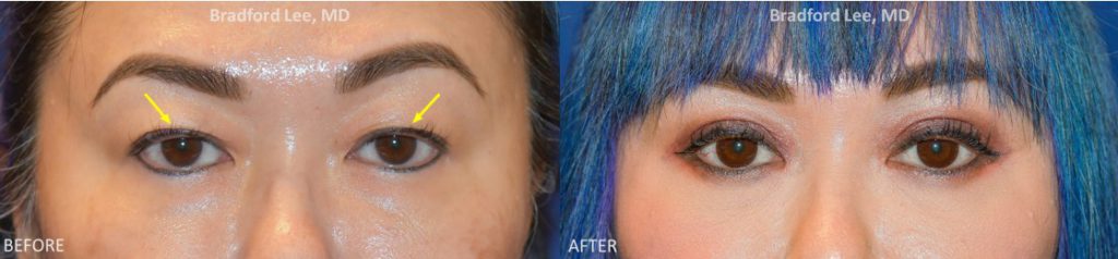 This lovely, young patient was noticing excess skin on her upper eyelids, difficulty seeing her eyelid crease, and the inability to do her eye makeup properly. She underwent an Asian blepharoplasty with the goal of making a higher, more prominent eyelid crease and being able to do her eye makeup to perfection!
